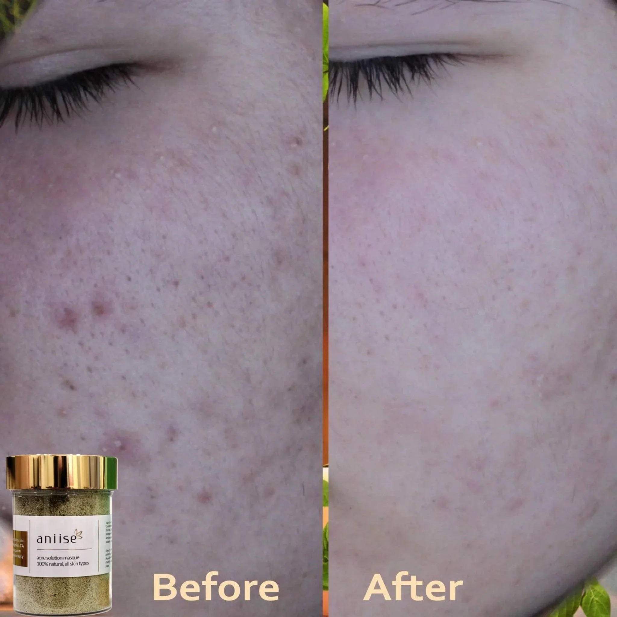 Before and after close-up of cheek showing acne improvement with Anise acne solution masque jar.
